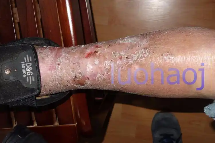 下肢顽固性湿疹伴溃疡案例 - 好大夫在线