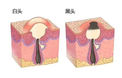 怎么祛除鼻翼黑头和额头闭口?