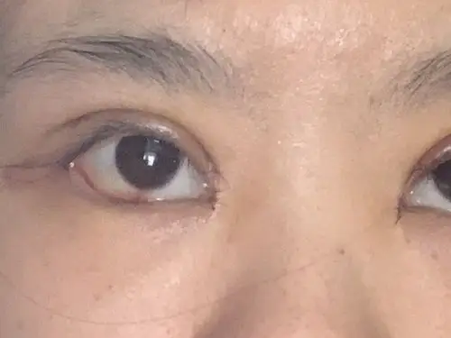 求问做过眼睑下至的妹子,我这种程度的露白,后期会回缩到正常吗?