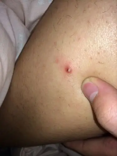 小腿上出来的小包,毛囊炎,里面长白肉,痒