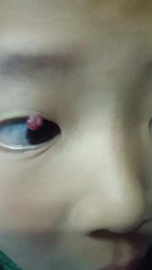 我小孩的眼皮上长个肉疙瘩,是什么东西,不疼不痒的