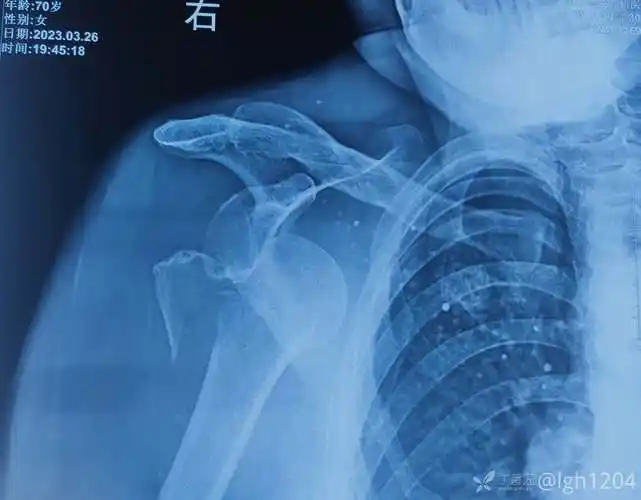 肩关节脱位合并大结节骨折