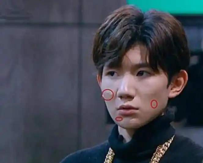 王源脸上痘痘照片,王源脸上的痘痘越发严重