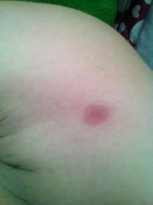 女性梅毒症状图片大全_有来医生