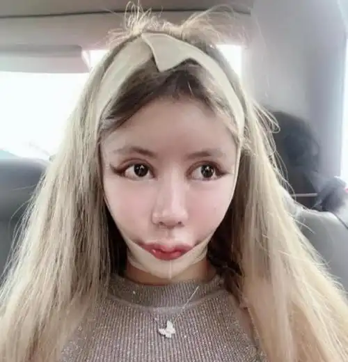 女孩13岁开始整容,砸100万整成"芭比娃娃",如今的脸一言难尽