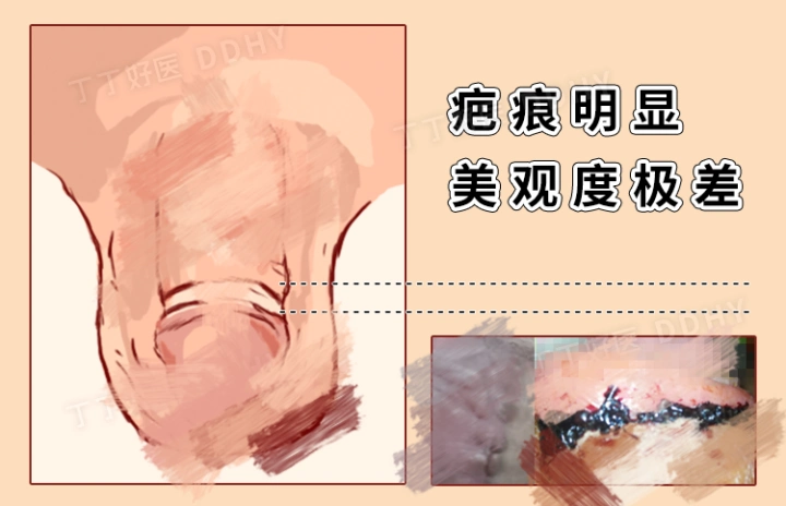 抖音小伙网购器械自己割包皮丁丁从5方面论证行不行