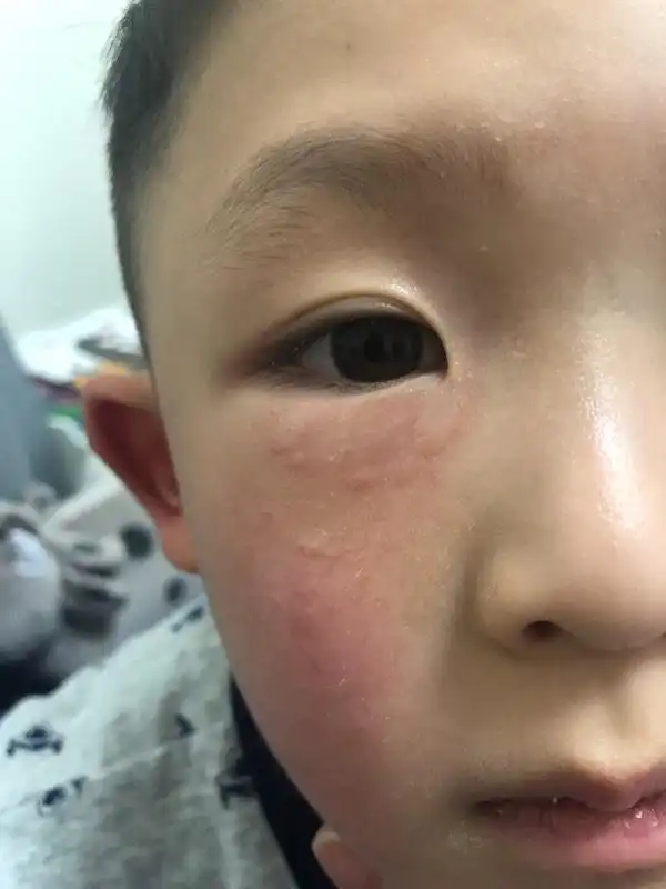 5岁宝宝眼袋长像蚊虫叮咬的包,连片的,全在眼袋上,请问是什么情况?
