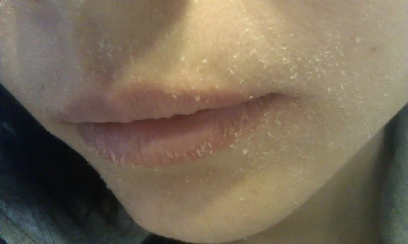 皮肤干成这样怎么办?