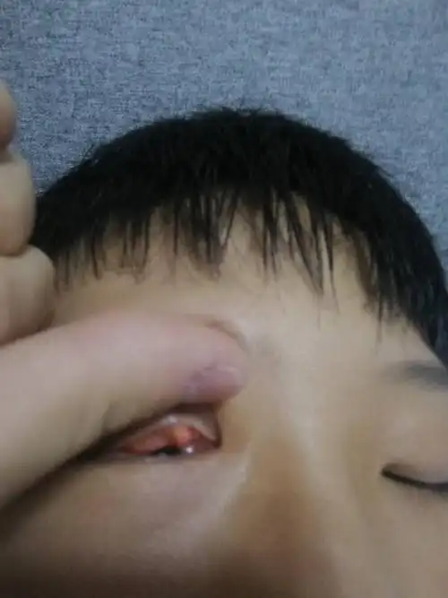 能帮我看看这是啥吗,已经半年多了,因为之前一直担