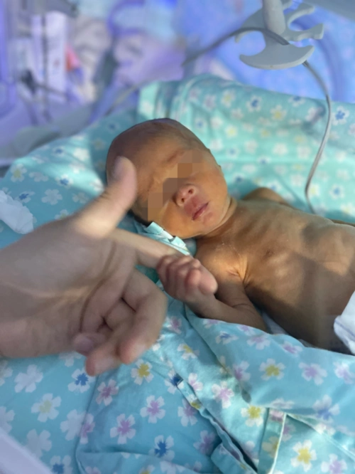 遵义这个不足3斤早产儿重获新生