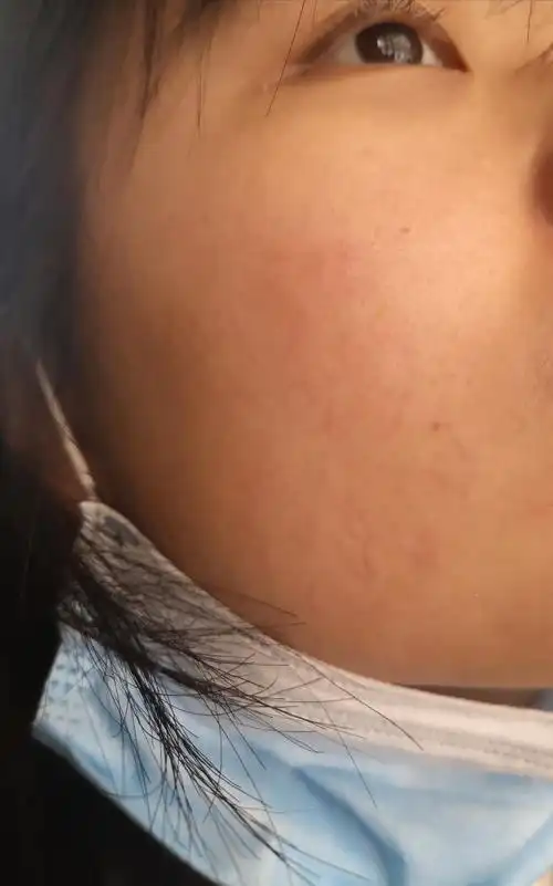 有脸上有红血丝的姐妹吗?