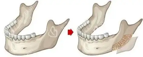 下颌骨外板位置示意图