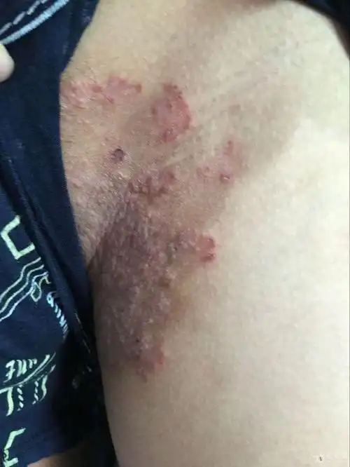 成年人严重股癣局部图片_有来医生