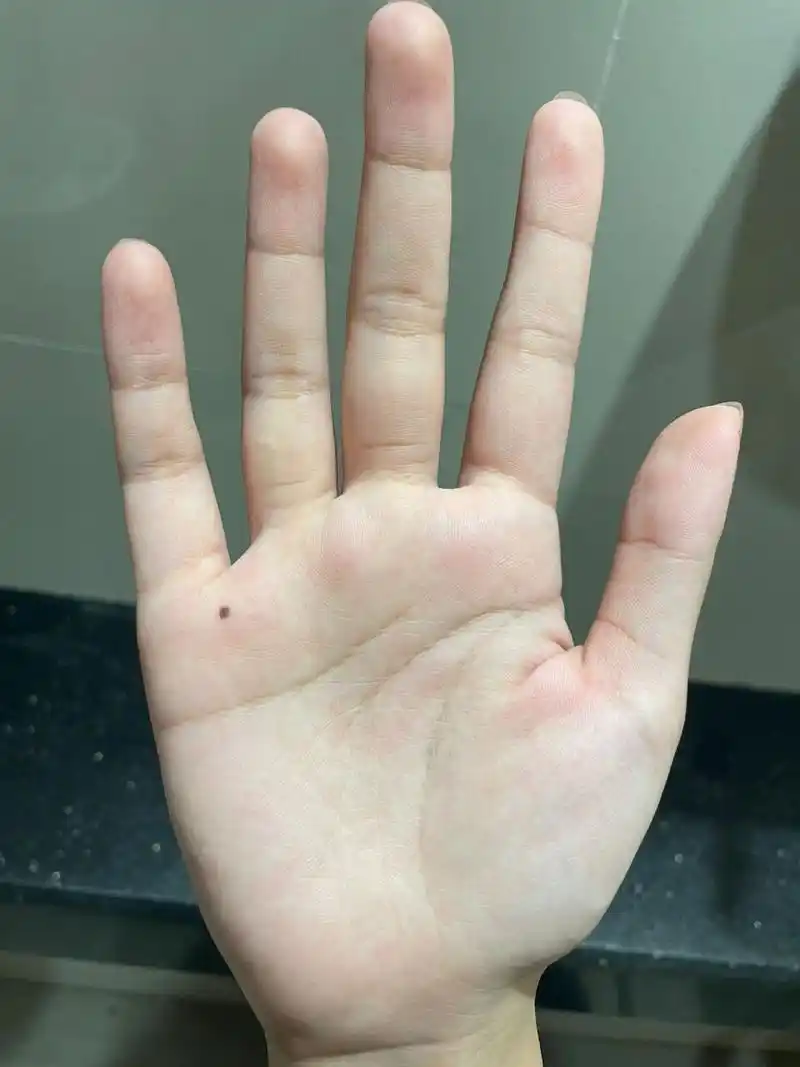 手心长痣 不知道什时候突然右手掌长了一颗大痣,这代表着什么04
