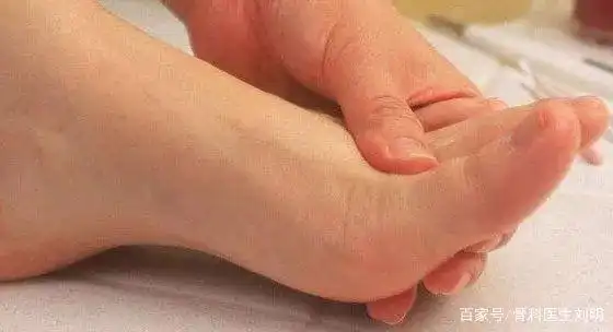 不用手术治疗拇外翻