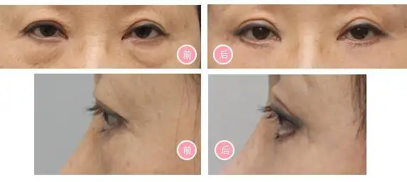 眼睑下垂矫正恢复眼部神采,重现闪亮双眸