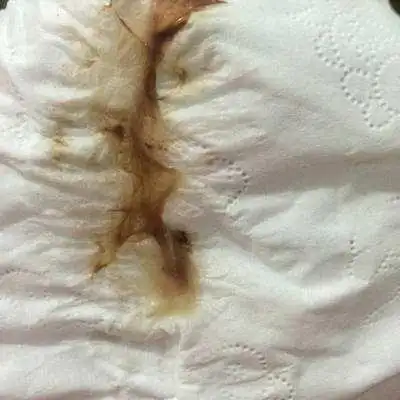 出现褐色分泌物还习以为然伤了胎儿还没发现孕妈别大意了