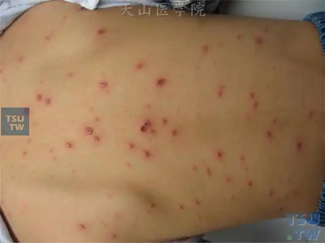 【图】水痘(varicella)症状表现 - 皮肤病诊断图谱 - 天山医学院