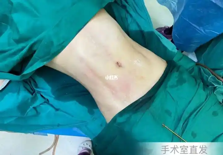 腰腹环吸77马甲线术后即刻