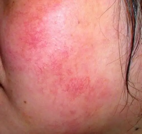 激素脸红血丝与普通红血丝的区别?