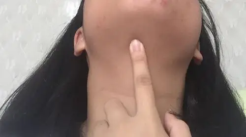 我的下巴疼痛貌似还有肿块已经疼痛几天了抬头还有转头的时候会伴