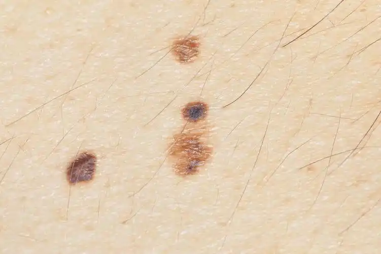 良性黑色素瘤图片黑色素瘤良性恶性区别