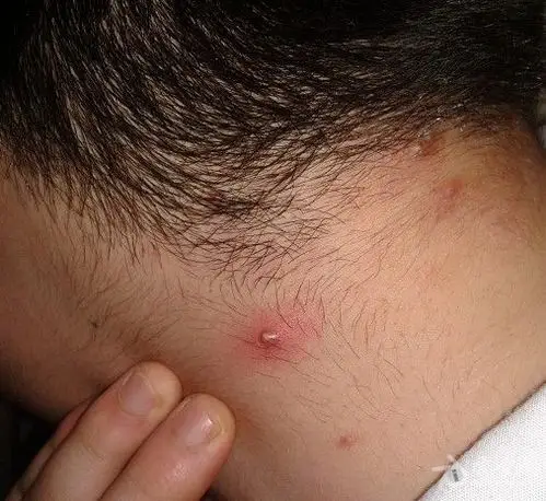 毛囊炎疖肿?求分析.治疗方法 !