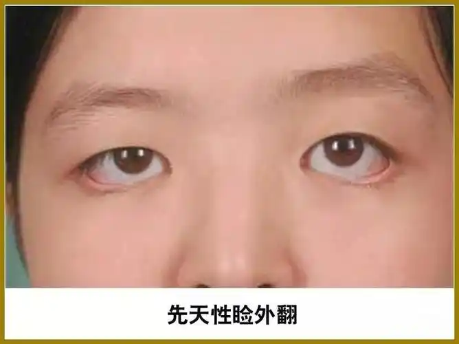 眼睑外翻_眼部整形_整形医生_医咖荟_分享