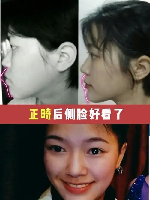 78戴牙套一年了,_圈子-新氧美容整形