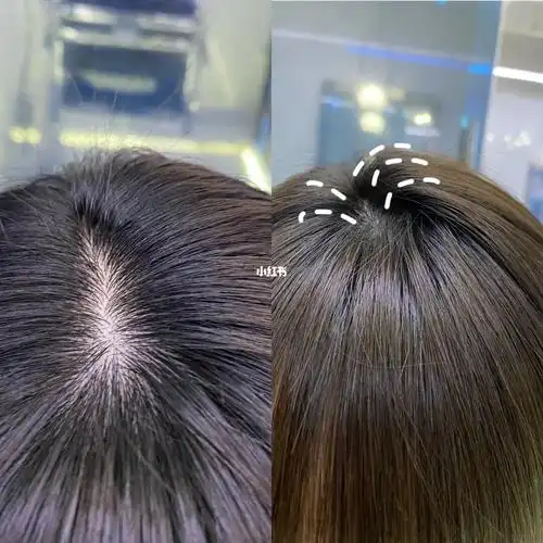 告别发根帖头皮