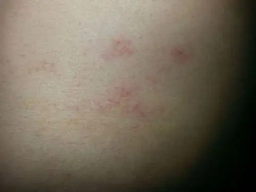 孕妇疥疮初期腹部皮肤症状图片