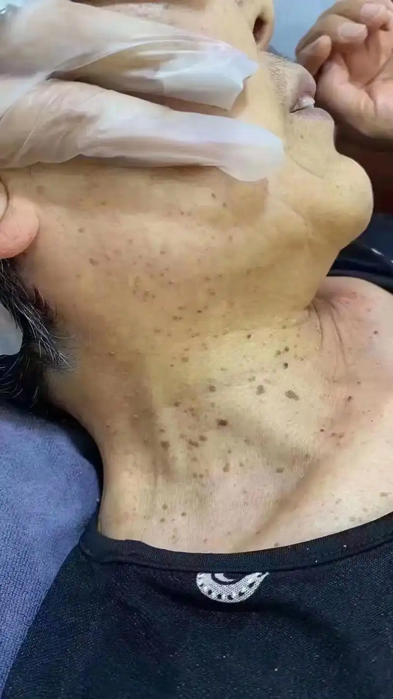 一颗疣你不在意,十颗疣还不在意 拖的久了发现满脖子,脸上,身 - 抖音