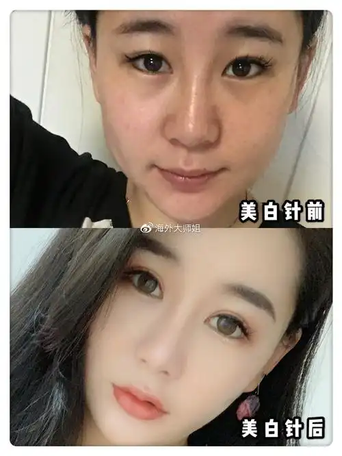 的后续护理一定要注意防晒和补水,术前出去玩的时候美白针前后对比术