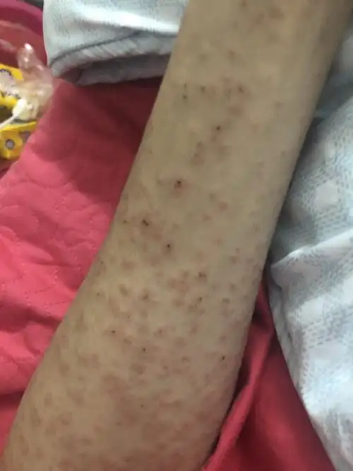 求助各路大神,这种情况是属于哪种过敏,全身都是,时不时会痒,应该