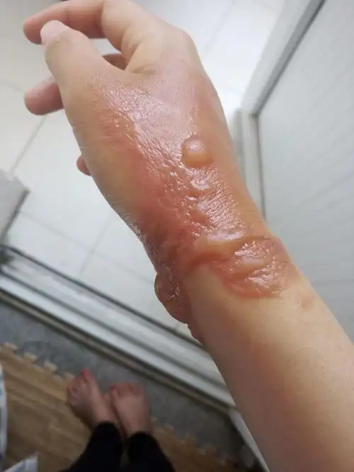 开水烫伤,听校医的没去医院,只抹了烫伤药,但水泡越来越大,皮肤颜色也