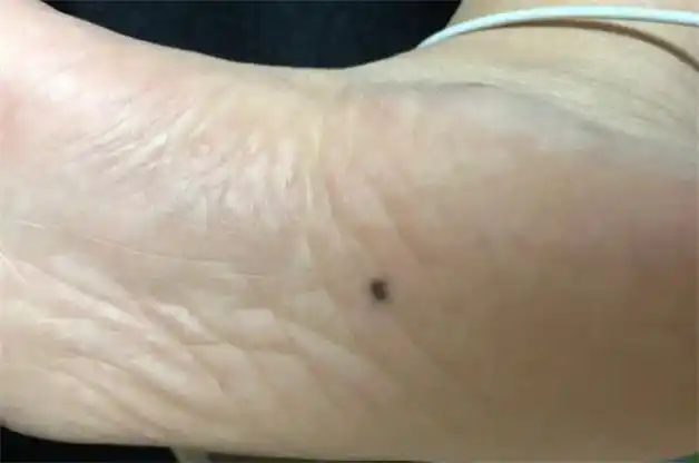 女人哪里长痣最好命呢