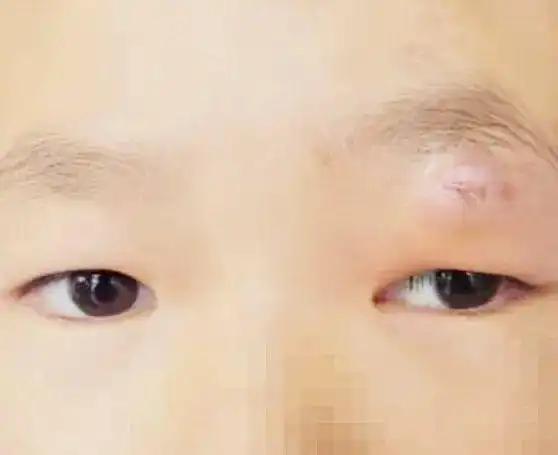 儿童眼外伤不可忽视!疯狂石头竟「深藏」在 9 岁女孩眼皮下一年之久