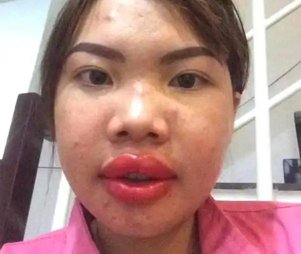 太丑没人娶, 整容后从丑女逆袭成女神,成功嫁给了富二代!