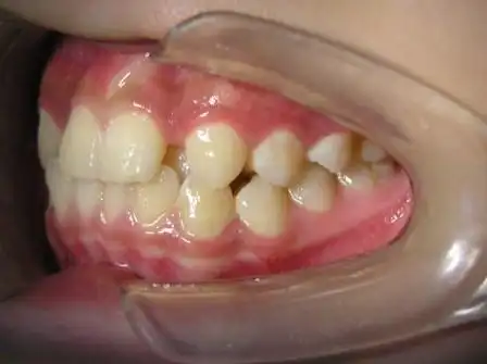 腭向错位的上侧切牙矫正过程组图原创