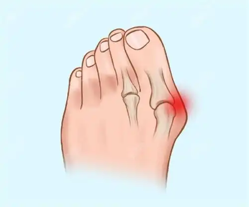 全国大脚骨好的医院排行国内大脚骨拇外翻医院排行