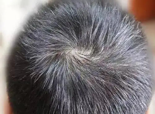 脾胃不和后,除了头上出现白发症状外,还容易出现口臭,青春痘,咽痛