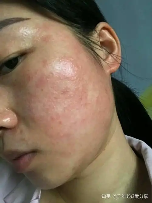 40以后的女性关于皮肤敏感问题. - 知乎