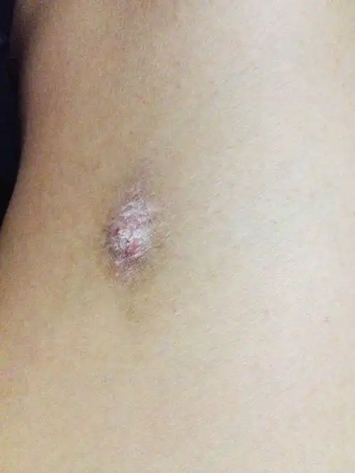 右大腿内侧有一小块小疙瘩,有5分硬币那