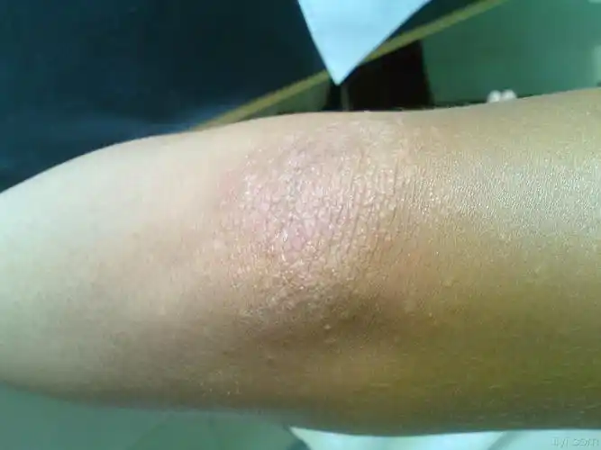 双手肘关节出现丘疹瘙痒一周 - 皮肤及性传播疾病讨