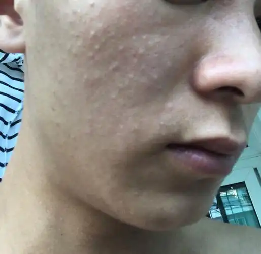 脸上有些应该是闭口粉刺 实在不知道怎么办