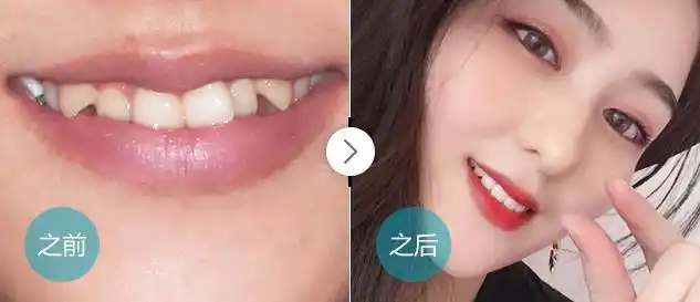 矫正虎牙,女孩变美丽自信