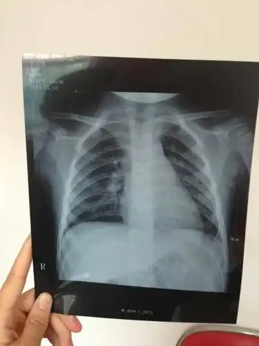 问:宝宝初步被诊断为支气管肺炎,平时精神很好,也能吃饭,就是总在后