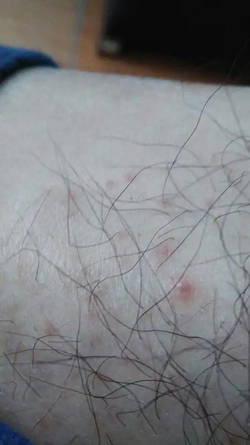 毛囊炎的初期症状及图片