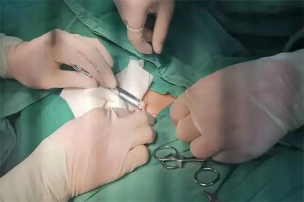 经过医生仔细检查,患儿确诊为"左侧腹股沟斜疝",需要尽早手术治疗.