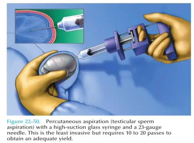 睾丸穿刺示意图